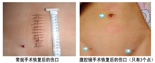 如何更早发现卵巢囊肿？