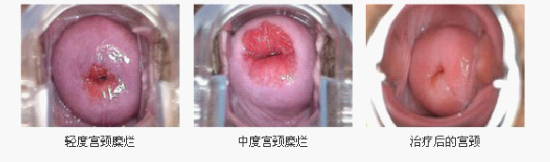 盘锦女性怎么样防治宫颈糜烂？